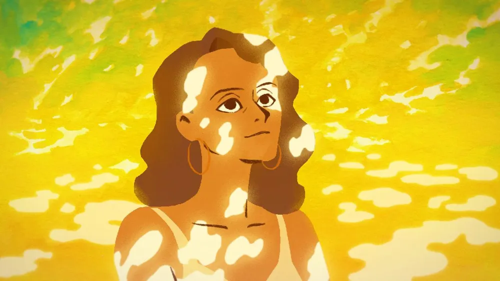 Living with Vitiligo: Strength Amidst the Spots