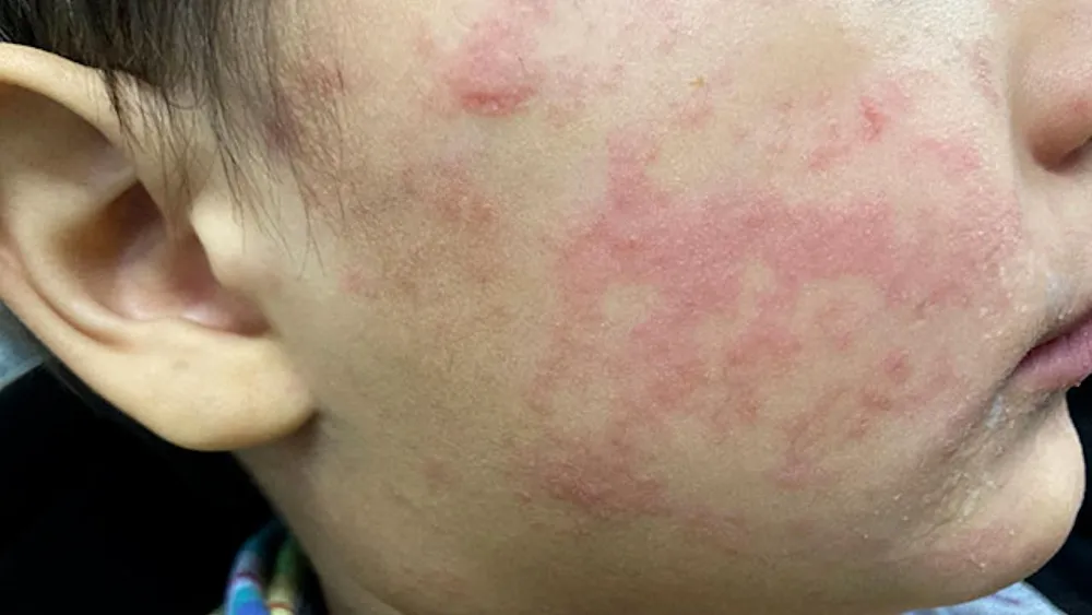 EE UU enfrenta el peor brote de sarampión en décadas