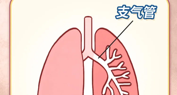 Tos cronica y esputo purulento ¿Cómo detectar bronquiectasia?