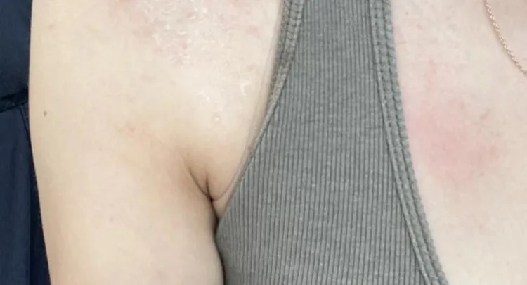 ¿por qué aparecen ampollas rojas tras el paseo al aire libre? causas y soluciones para la dermatitis