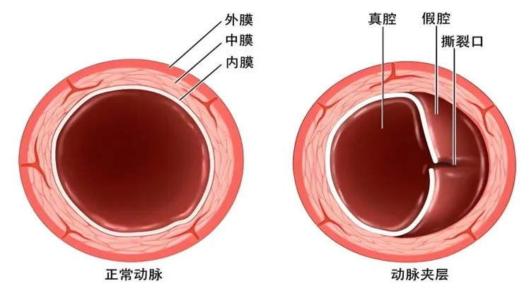 ¡atención al dolor abdominal súbito! puede ser disección de arteria mesentérica